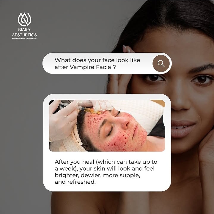 Niara Aesthetics Vampire Facial social creative